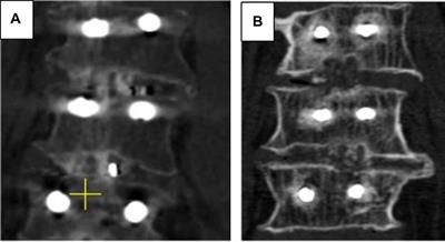 Supplementary posterior fusion in patients operated on employing TLIF may decrease the instrumentation failure rate